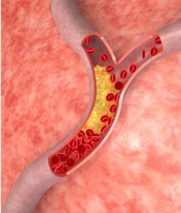 Diagram showing lipoprotein transport system and cholesterol movement to help reverse type 2 diabetes